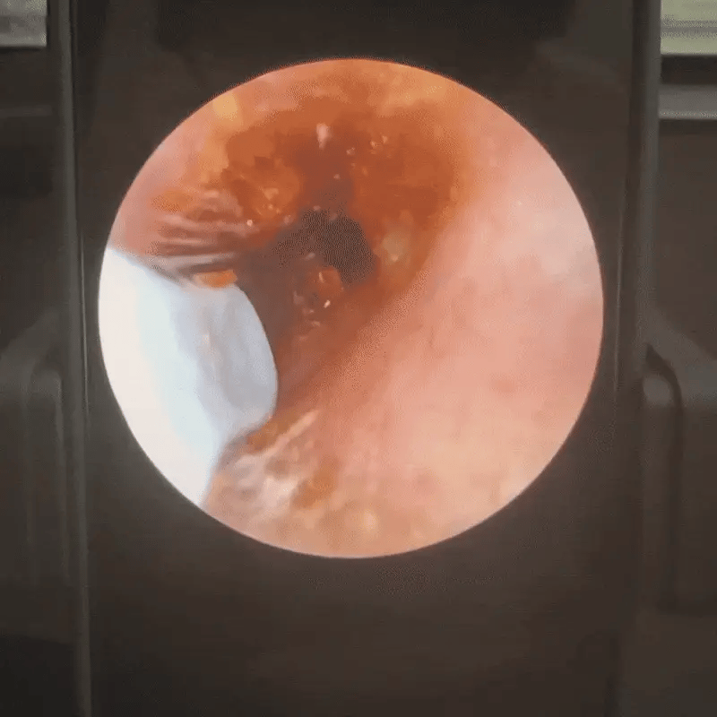 ClearView™ EarCare Kit